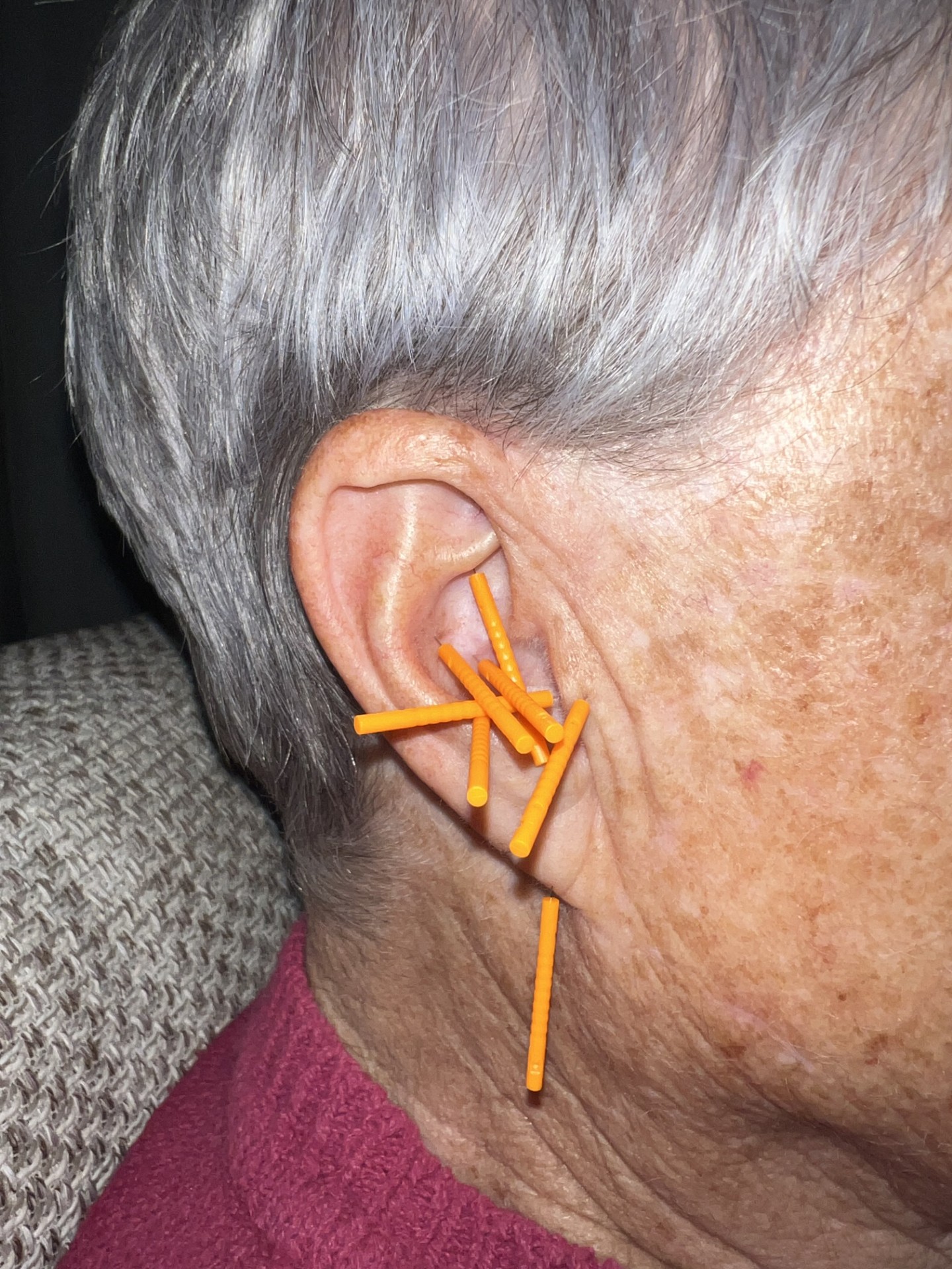 Auricular acupuncture treatment on a client's ear at Serenity Points, Birkenhead