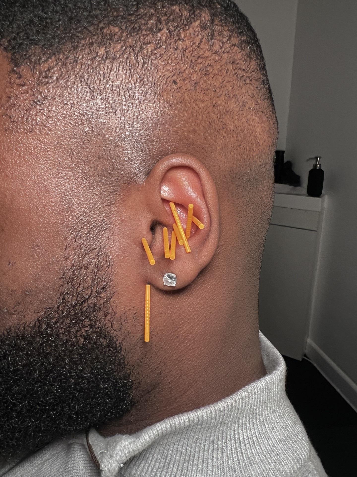 Mia applying auricular acupuncture to a client at Serenity Points, Birkenhead